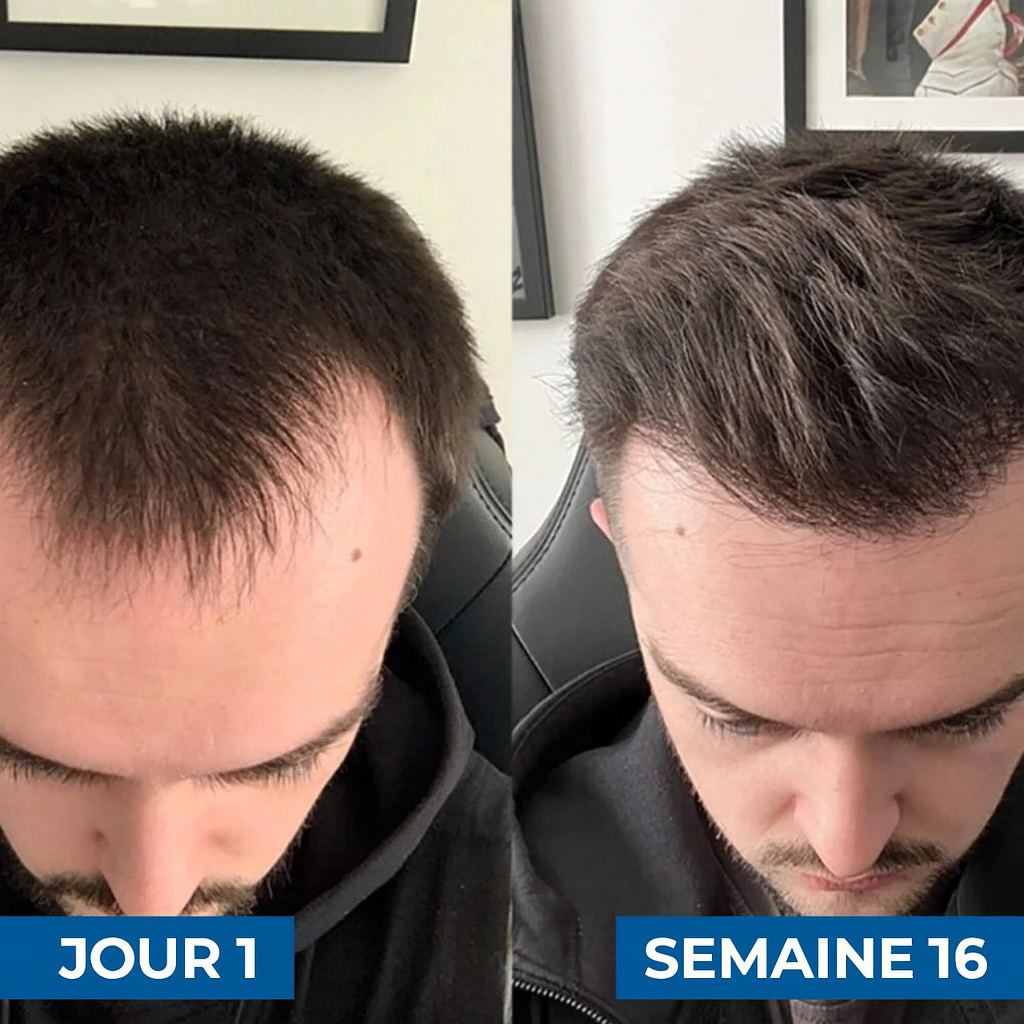 Arrêtez la chute de cheveux naturellement
